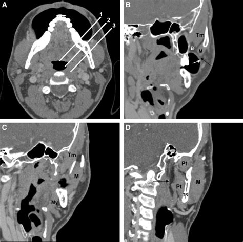 A 35 Year Old Man Normal Subject Coronal Oblique Reconstructions A