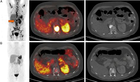 Near Complete Remission Illustrated By 68 Ga DOTATOC PET CT Before A