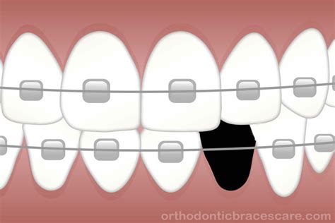 How To Cut Poking Braces Wire At Home Orthodontic Braces Care