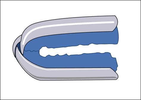 Fingertip (Tuft) Fractures | Anesthesia Key