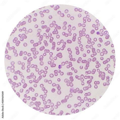 Babesia Parasites Inside Red Blood Cell The Causative Agent Of