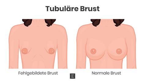 Tubul Re Brust Schlauchbrust Korrigieren Dr Eder