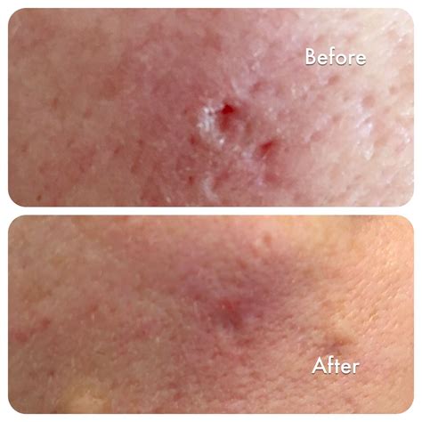 Smart Prp Treatment For Acne Scarring Vampire Facelift Dr Anil