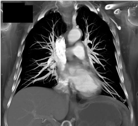 Multiple Bilateral Pulmonary Arteriovenous Malformations Pavms In A