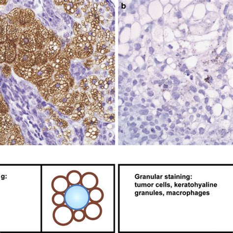 Pdf Adipophilin Expression In Sebaceous Tumors And Other Cutaneous