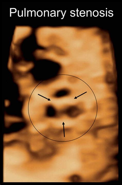 Pulmonary Stenosis Pulmonary Atresia With Intact Ventricular Septum And Ductus Arteriosus