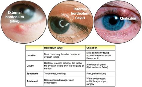 Uveitis Vs Conjunctivitis