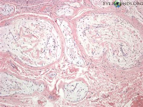 Plexiform neurofibroma. Online Atlas of Ophthalmology :: The University of Iowa, Ophthalmology