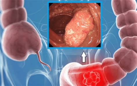 Overview Of Colorectal Polyps Vinmec