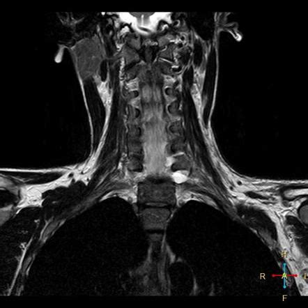 Traumatic Brachial Plexus Injury Image Radiopaedia Org