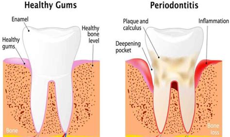 Costa Rica Dental Center Discount Prices Periodontal