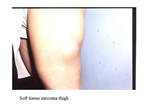 Soft tissue sarcomas of adults Soft Tissue Sarcoma