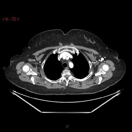 Sternalis Muscle And Right Intramuscular Lipoma Of Subscapularis Muscle