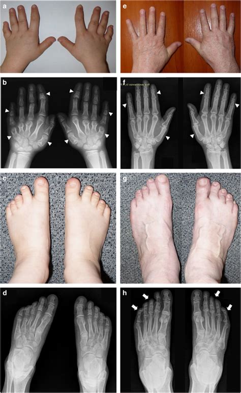 Clinically And Radiologically Variable Presentation Of BDE In The