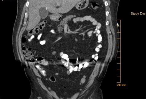 Mirizzi syndrome: Case report and review of literature | Published in ...