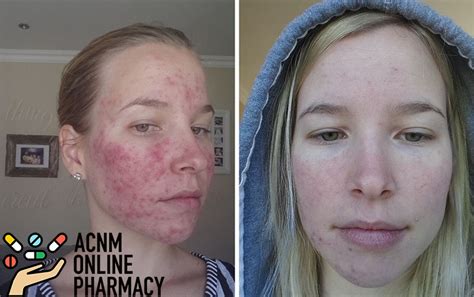 Accutane: Acne Treatment drug reviews, pics before and after, cost and administration