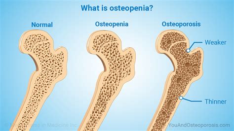 Slide Show Understanding Bone Health And Osteoporosis