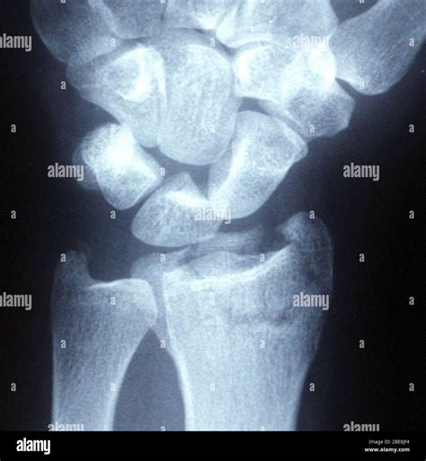 Sui Interpretativo Fluctuar Fractura Intraarticular Mu Eca Dar A