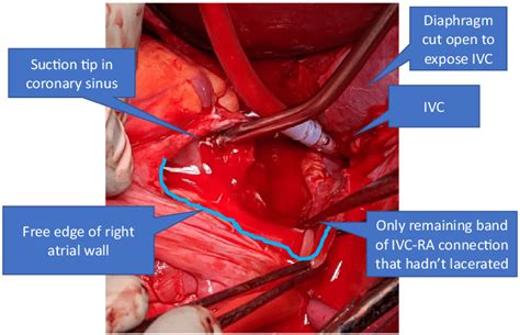 Defining And Exposing The Extent Of The Inferior Vena Cava Ivc Injury