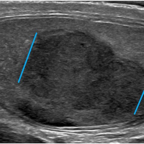 Scrotal Ultrasound Scrotal Ultrasound Demonstrates Enlarged Left