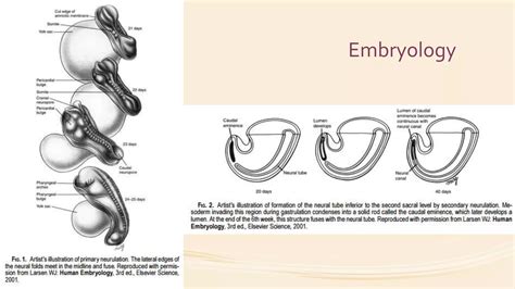 Tethered Cord Syndrome Ppt