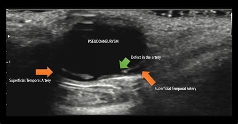 Ultimate Radiology Superficial Temporal Artery Pseudoaneurysm