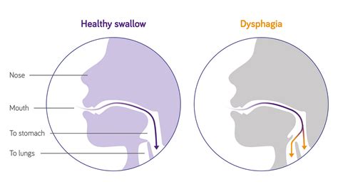 Understanding Dysphagia After Stroke Causes And Recovery Techniques