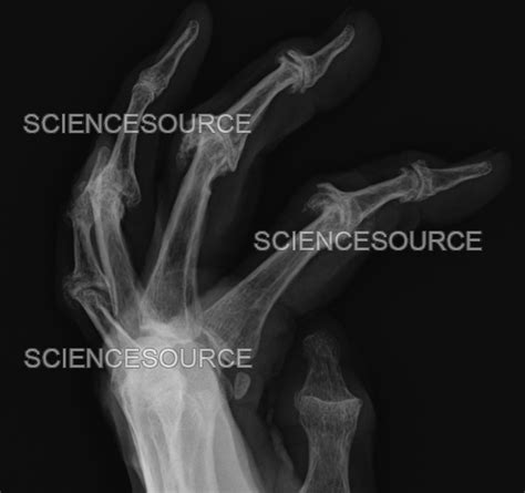 Psoriatic Arthritis X Ray