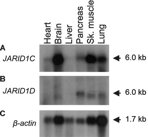 Mutations In The Jarid C Gene Which Is Involved In Transcriptional