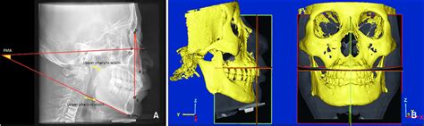 A Lateral Cephalometric Radiograph Illustrating The Cephalometric