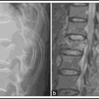 (a) L1 vertebral burst fracture, and (b) Hyperintense signal of PLC on ...