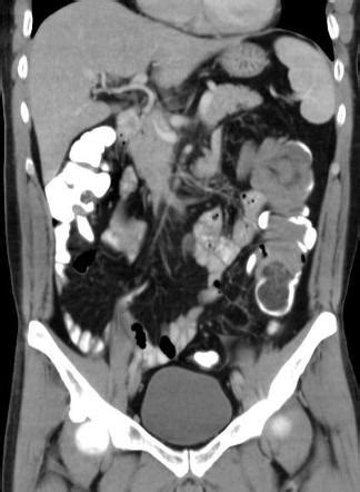 Colocolic Intussusception Radiology Case Radiopaedia Org