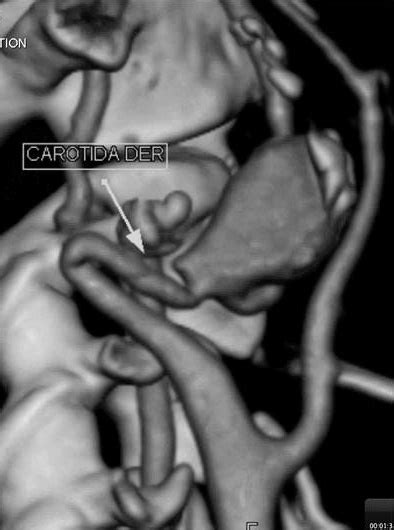 D Angio Ct Scan Lateral Viev Of The Right Carotid Axis Download Scientific Diagram