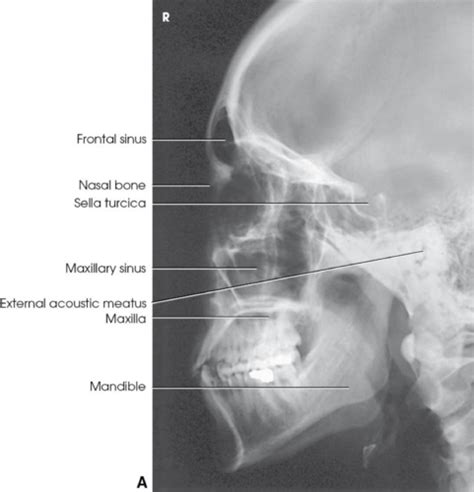 X Ray Images Facial Bones To Mandible TMJ Flashcards Quizlet