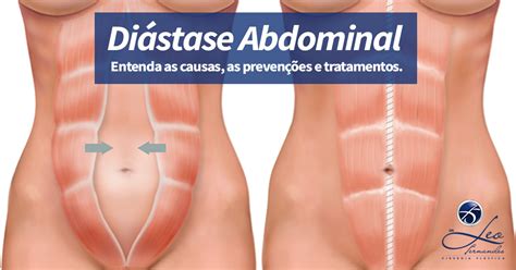 Di Stase Abdominal Afastamento Dos M Sculos Abdominais Saiba Mais