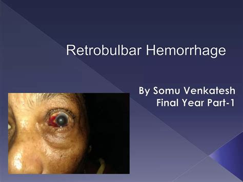 Retrobulbar Hemorrhage By Somu Venkatesh Ppt