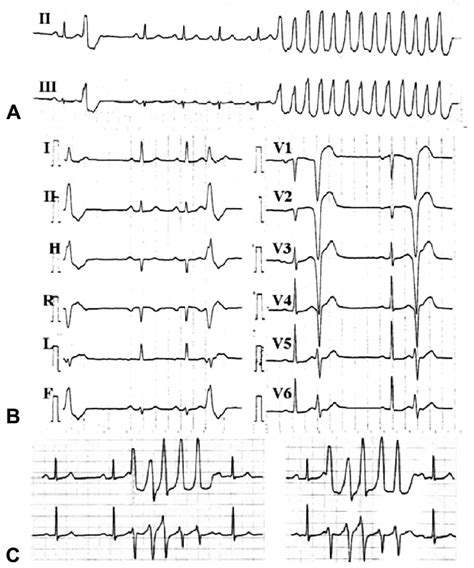 Typical non-sustained monomorphic VT originated from an extrasystole ...