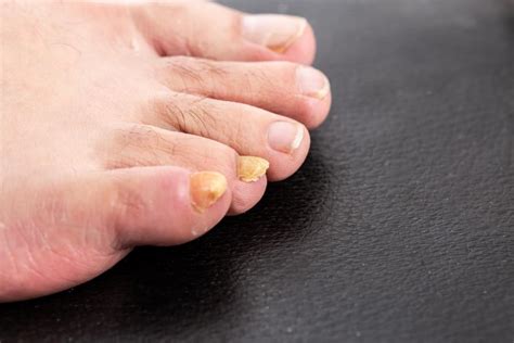 Treating Toenail Fungus: Lawrence E. Lloyd, DPM, FACFAS: Board ...