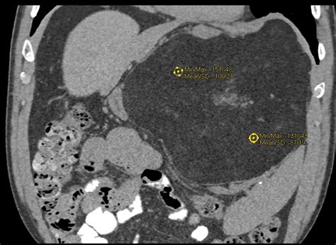 Retroperitoneal Liposarcoma Gastrointestinal Case Studies Ctisus Ct