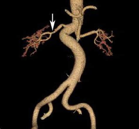 Ct Angiography Of Renal Arteries Performed 10 Weeks After Renal Download Scientific Diagram