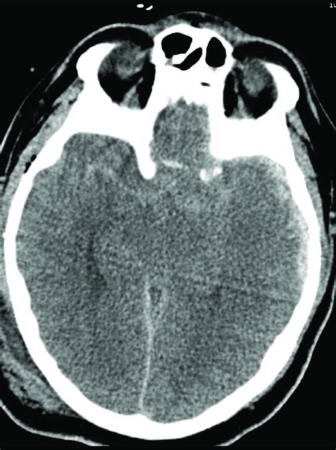 Presenting Head Ct Showing Effaced Suprasellar Cistern And