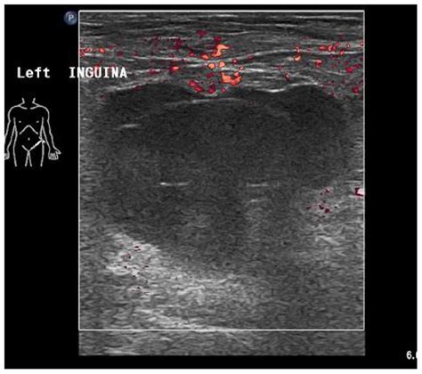 Inguinal Abscess