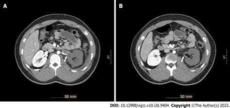 Antiphospholipid Syndrome With Renal And Splenic Infarction After Blunt