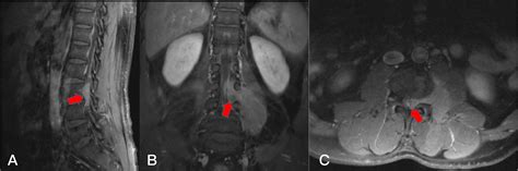 Frontiers Feasibility And Efficacy Of Spinal Microtubular Technique