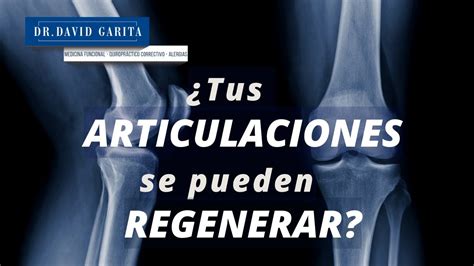 Sí se pueden regenerar tus articulaciones sin cirugías y sin dolor