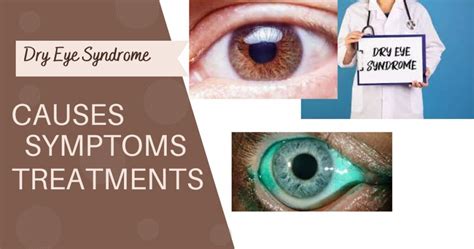 "Unlocking The Mystery Of Dry Eye Syndrome: Causes, Top 10 Symptoms ...