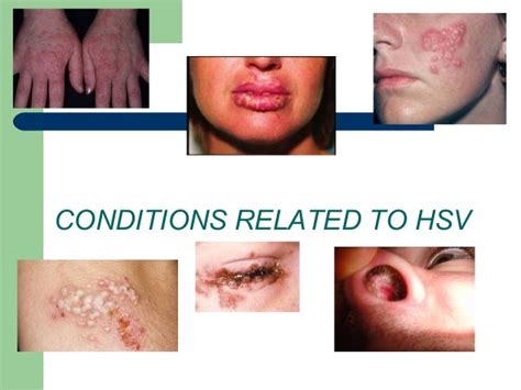 Herpes Simplex