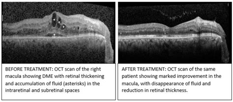 Diabetic Macular Edema Dme Oasiseye Specialists