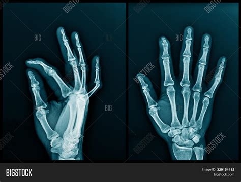 X-ray Image Lumbar Image & Photo (Free Trial) | Bigstock