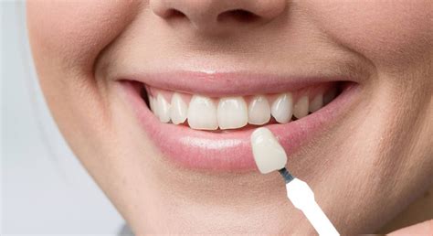 Dental Veneers In Gurgaon Cost Of Porcelain Veneers In Gurgaon India